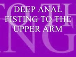 DEEP ANAL FISTING TO THE UPPER ARM